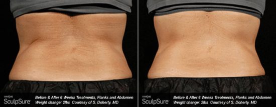 6 weeks after 2 Tx of SculpSure body contouring/body sculpting sessions for flanks and belly