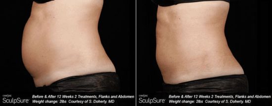 12 weeks after 2 Tx of SculpSure body contouring/body sculpting sessions for flanks and abdomen