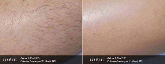 Best Laser Hair Removal - Leg, Toronto Clinic