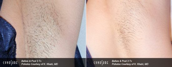 Laser Hair Removal North York Clinic - Under Arms