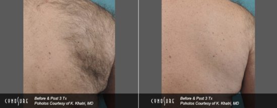 Laser Hair Removal Toronto Clinic - Shoulders