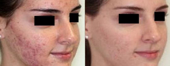 acne on face and forehead