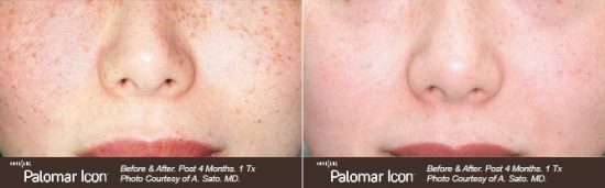 freckles skin pigmentation treatments in Toronto