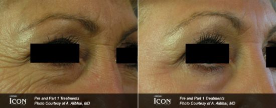 Laser skin resurfacing before and after